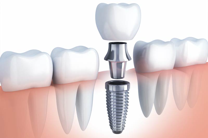 Implants Dentist in Vista