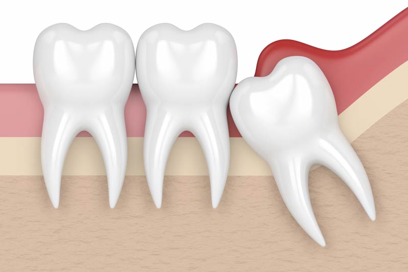 Wisdom Tooth Removal in Vista